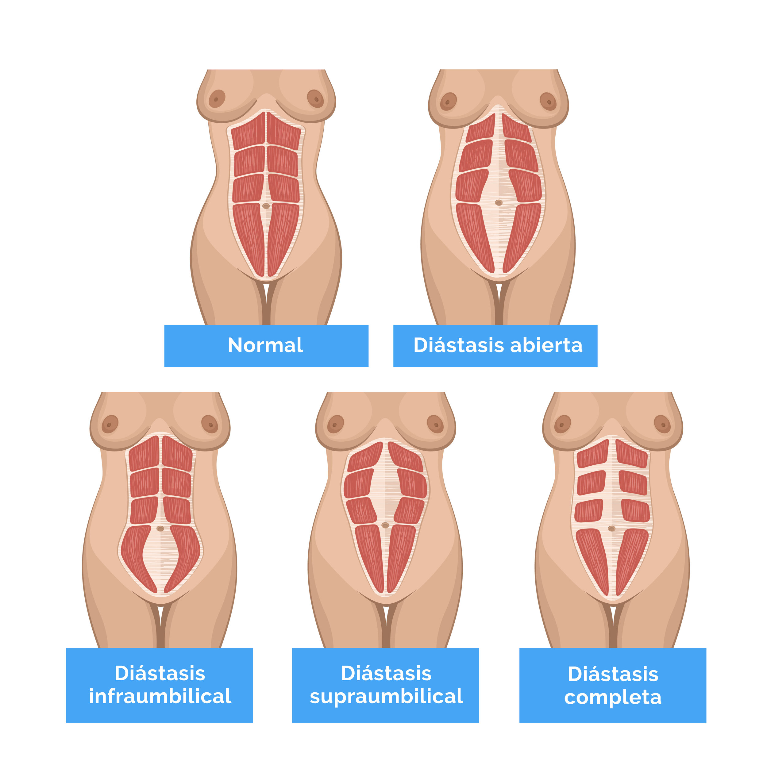 La hernia umbilical durante y después del embarazo